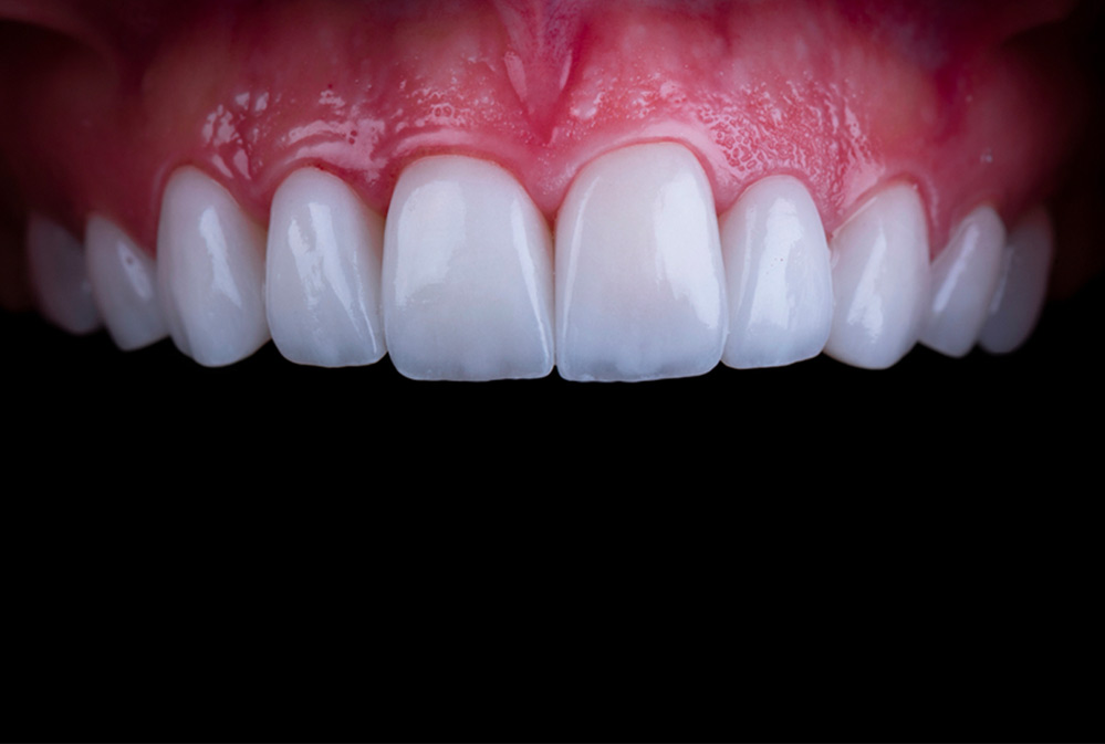 Estética Dental e Facetas